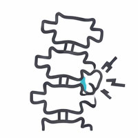 脊椎小面關節炎